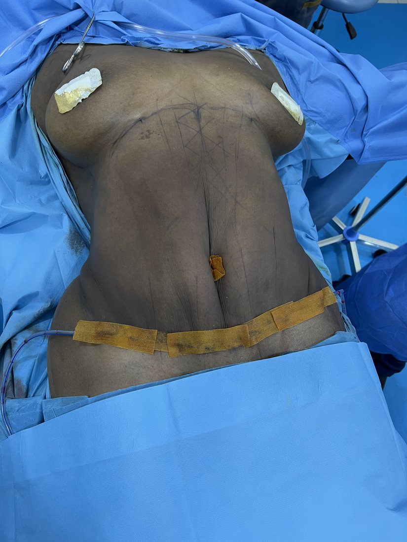 Tummy tuck photo 12