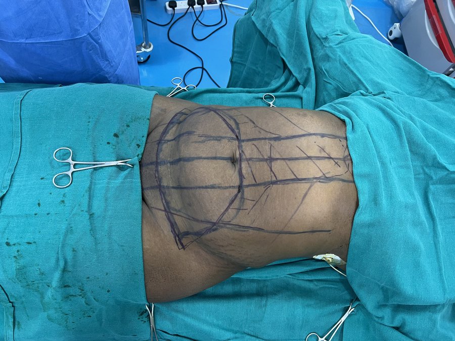 Tummy tuck photo 15
