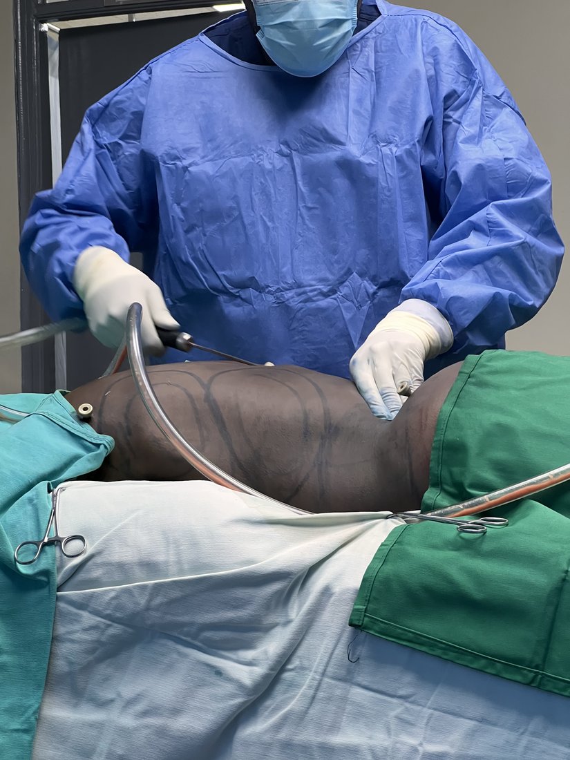 Reduction Mammoplasty at Truffel Healthcare